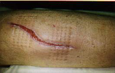 Diabetic Seniors Should Avoid Barefoot Walking on Cobblestone Paths