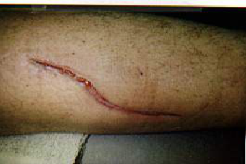 Diabetic Seniors Should Avoid Barefoot Walking on Cobblestone Paths